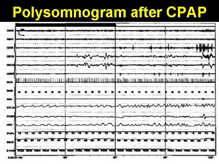 Polysomnogram after CPAP 