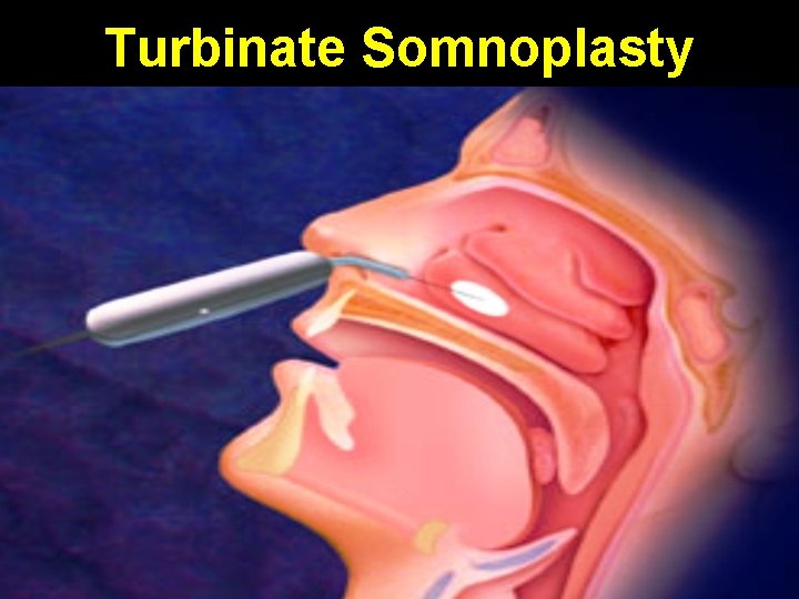 Turbinate Somnoplasty 