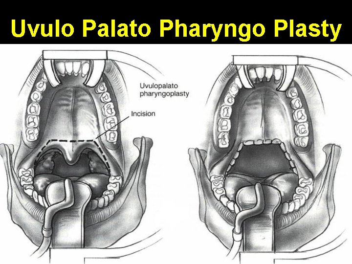Uvulo Palato Pharyngo Plasty 