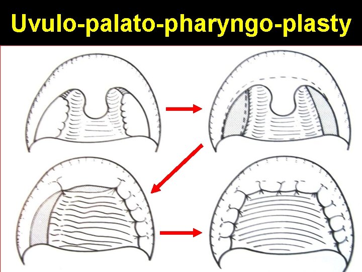 Uvulo-palato-pharyngo-plasty 