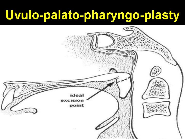 Uvulo-palato-pharyngo-plasty 