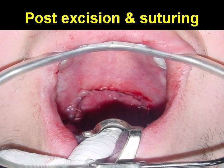 Post excision & suturing 