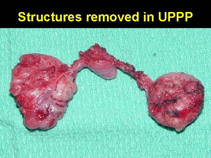 Structures removed in UPPP 