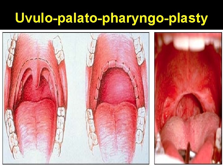 Uvulo-palato-pharyngo-plasty 
