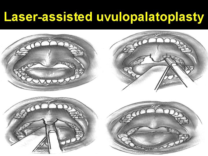 Laser-assisted uvulopalatoplasty 