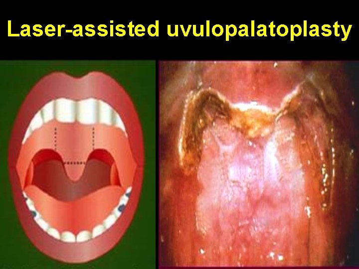Laser-assisted uvulopalatoplasty 