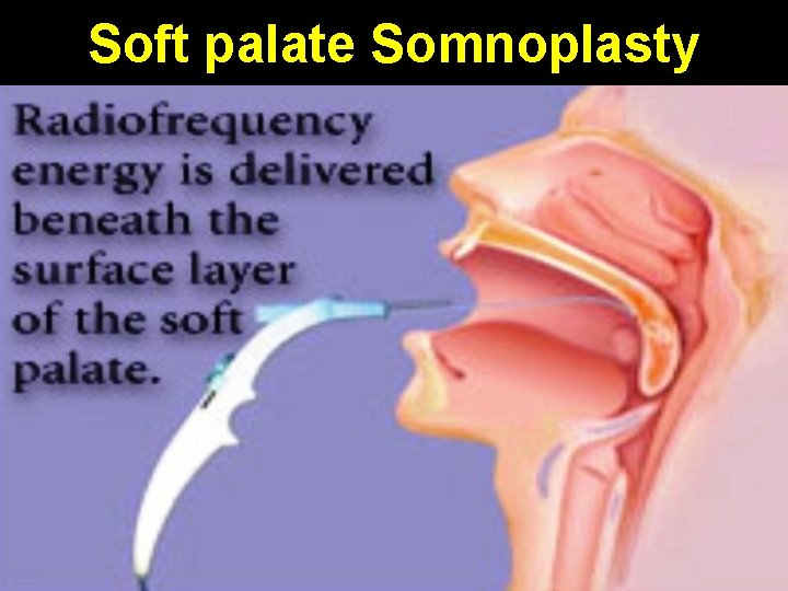 Soft palate Somnoplasty 