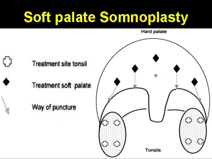 Soft palate Somnoplasty 