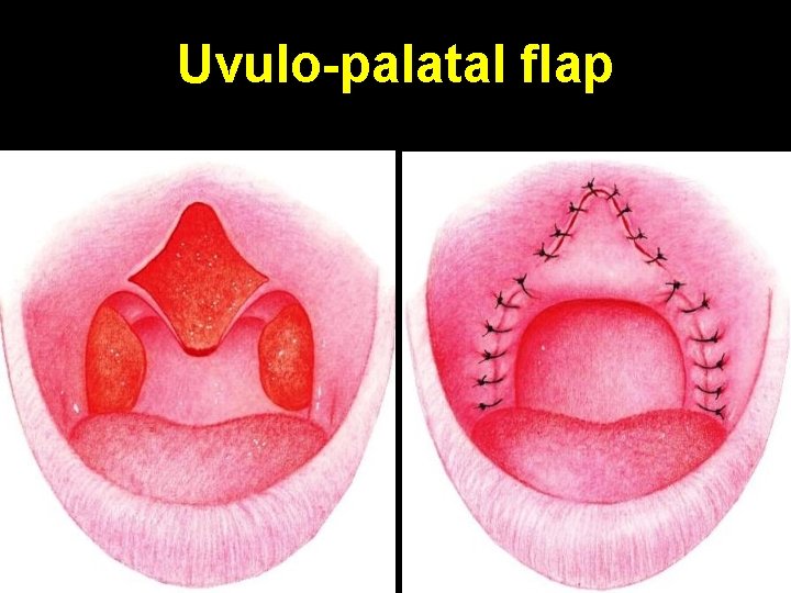 Uvulo-palatal flap 