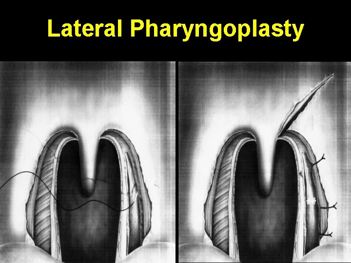Lateral Pharyngoplasty 