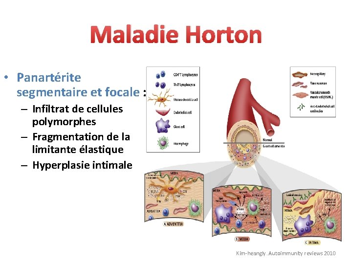 Maladie Horton • Panartérite segmentaire et focale : – Infiltrat de cellules polymorphes –