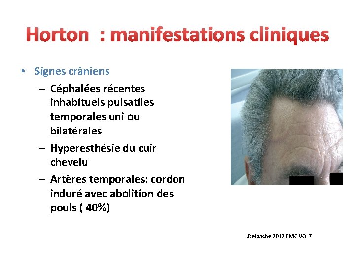 Horton : manifestations cliniques • Signes crâniens – Céphalées récentes inhabituels pulsatiles temporales uni