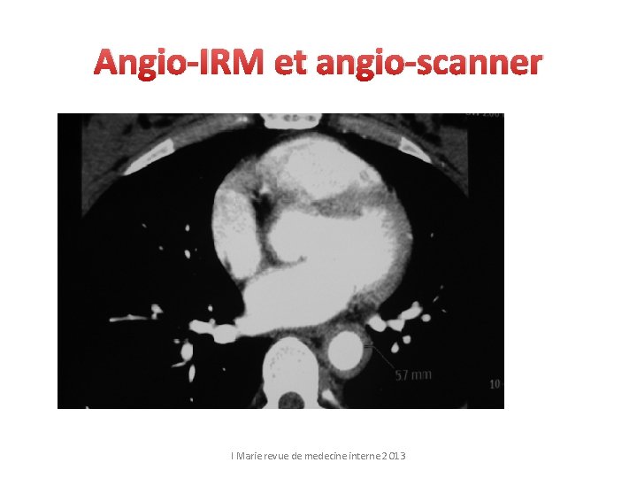 Angio-IRM et angio-scanner I Marie revue de medecine interne 2 O 13 