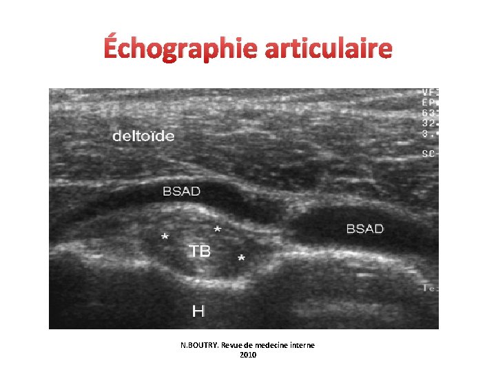 Échographie articulaire N. BOUTRY. Revue de medecine interne 2010 