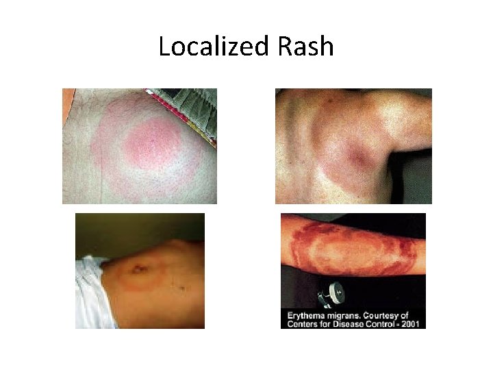 Localized Rash 