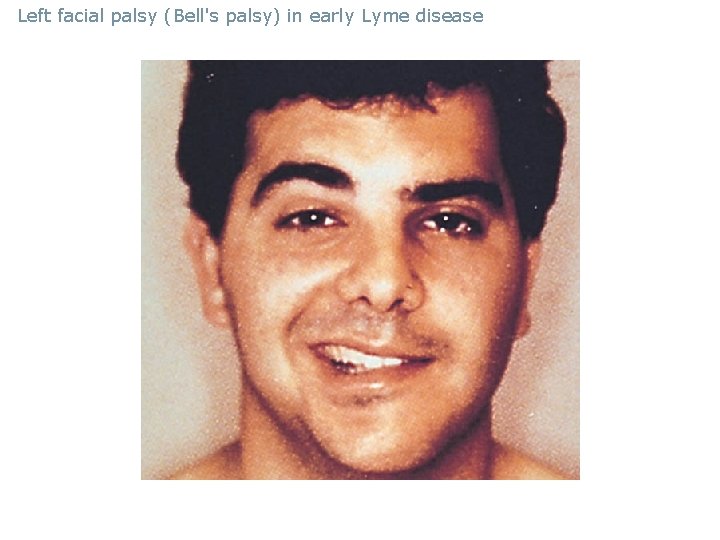 Left facial palsy (Bell's palsy) in early Lyme disease 