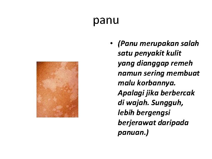 panu • (Panu merupakan salah satu penyakit kulit yang dianggap remeh namun sering membuat