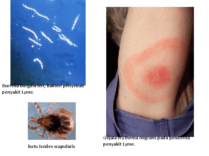 Borrelia burgdorferi, bakteri penyebab penyakit Lyme. kutu Ixodes scapularis Gejala erythema migrans pada penderita