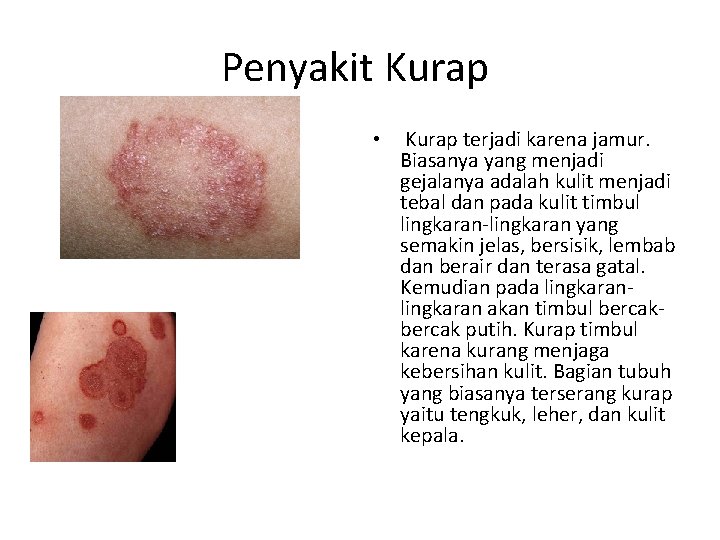 Penyakit Kurap • Kurap terjadi karena jamur. Biasanya yang menjadi gejalanya adalah kulit menjadi