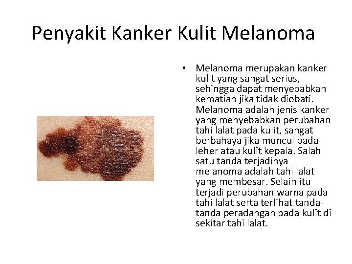 Penyakit Kanker Kulit Melanoma • Melanoma merupakan kanker kulit yang sangat serius, sehingga dapat