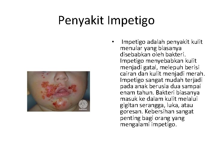 Penyakit Impetigo • Impetigo adalah penyakit kulit menular yang biasanya disebabkan oleh bakteri. Impetigo