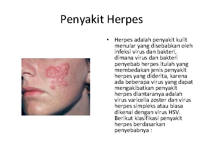 Penyakit Herpes • Herpes adalah penyakit kulit menular yang disebabkan oleh infeksi virus dan