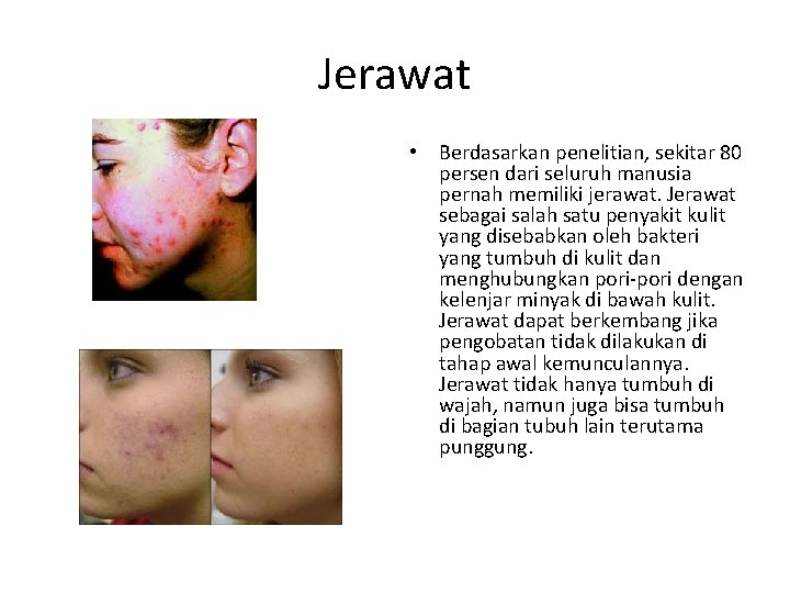  Jerawat • Berdasarkan penelitian, sekitar 80 persen dari seluruh manusia pernah memiliki jerawat.