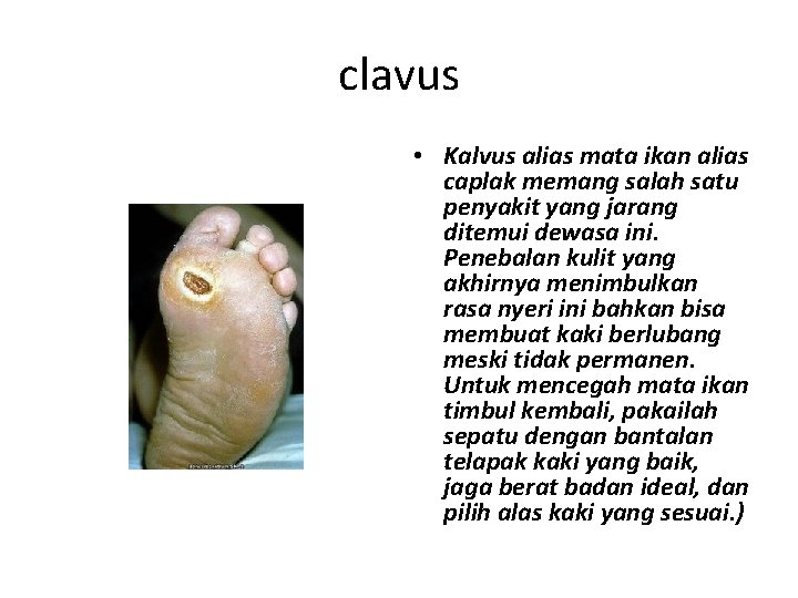 clavus • Kalvus alias mata ikan alias caplak memang salah satu penyakit yang jarang