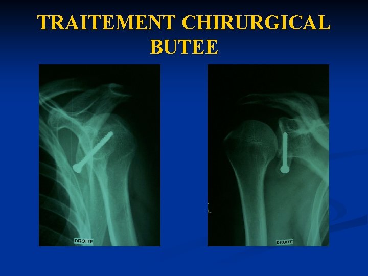 TRAITEMENT CHIRURGICAL BUTEE 