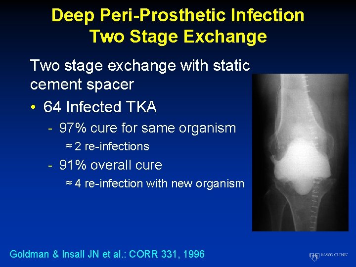 Deep Peri-Prosthetic Infection Two Stage Exchange Two stage exchange with static cement spacer •