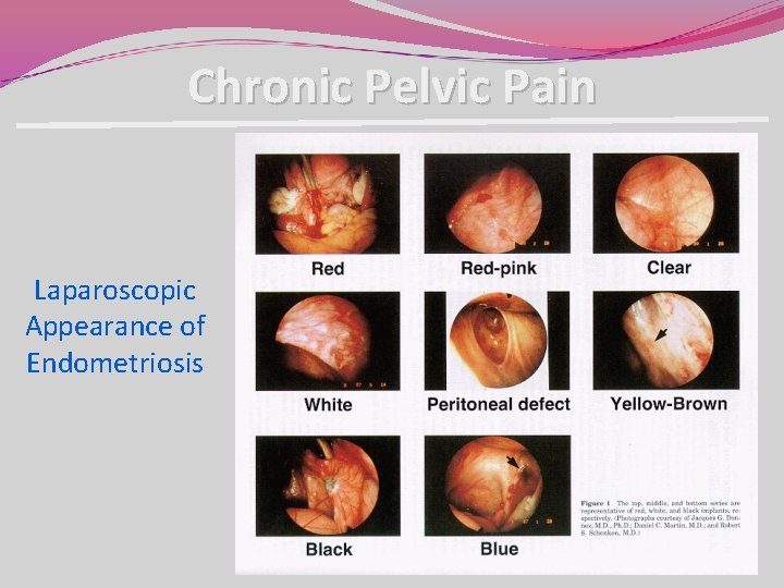 Chronic Pelvic Pain Laparoscopic Appearance of Endometriosis Chronic Pelvic Pain Laparoscopic Appearance of Endometriosis