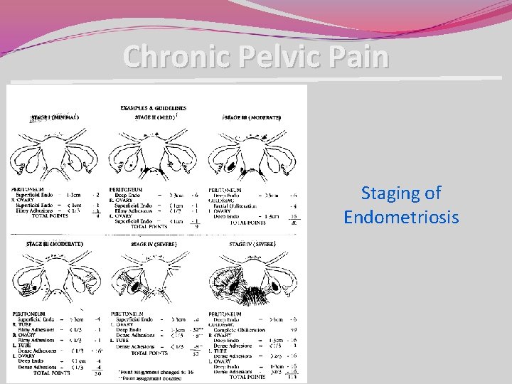 Chronic Pelvic Pain Staging of Endometriosis Chronic Pelvic Pain Staging of Endometriosis
