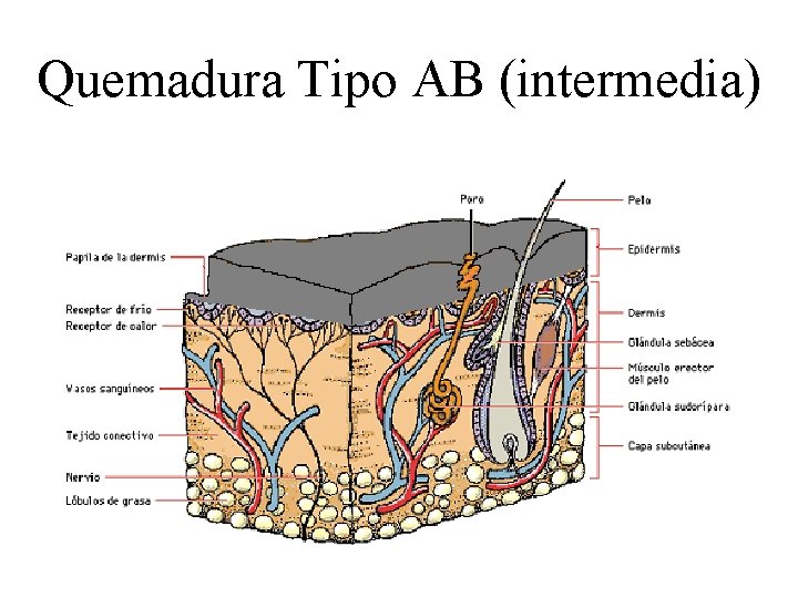 Quemadura Tipo AB (intermedia) 