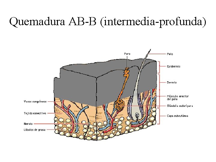 Quemadura AB-B (intermedia-profunda) 