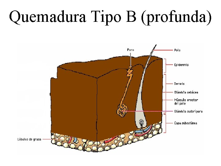 Quemadura Tipo B (profunda) 