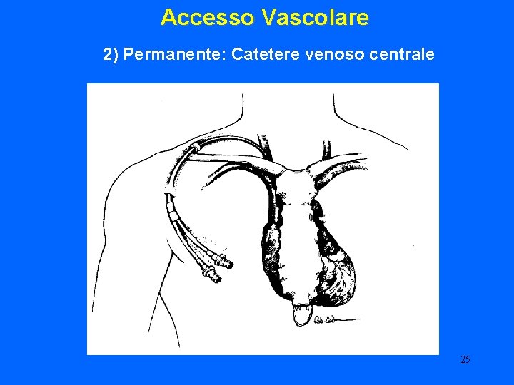 Accesso Vascolare 2) Permanente: Catetere venoso centrale 25 