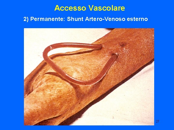 Accesso Vascolare 2) Permanente: Shunt Artero-Venoso esterno 27 