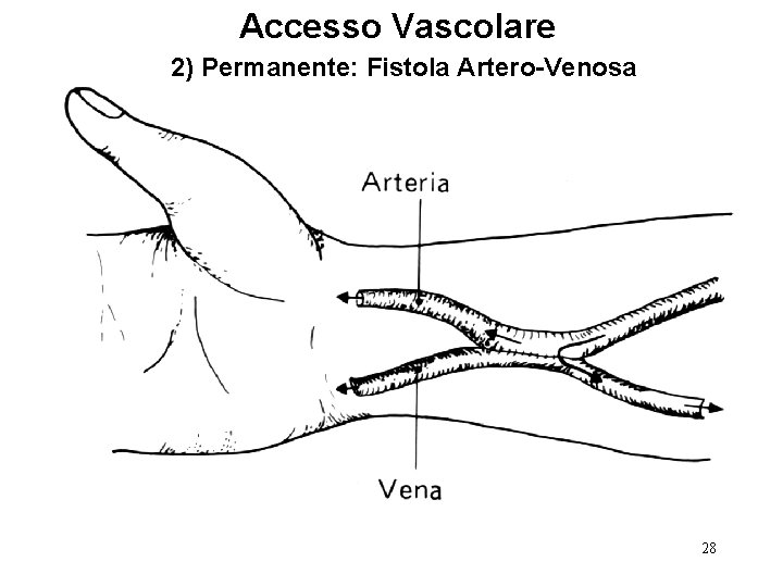 Accesso Vascolare 2) Permanente: Fistola Artero-Venosa 28 