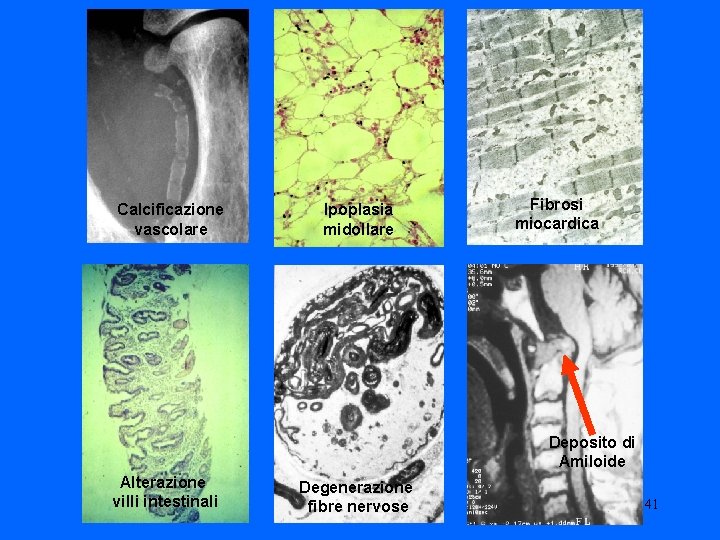 Calcificazione vascolare Ipoplasia midollare Fibrosi miocardica Deposito di Amiloide Alterazione villi intestinali Degenerazione fibre