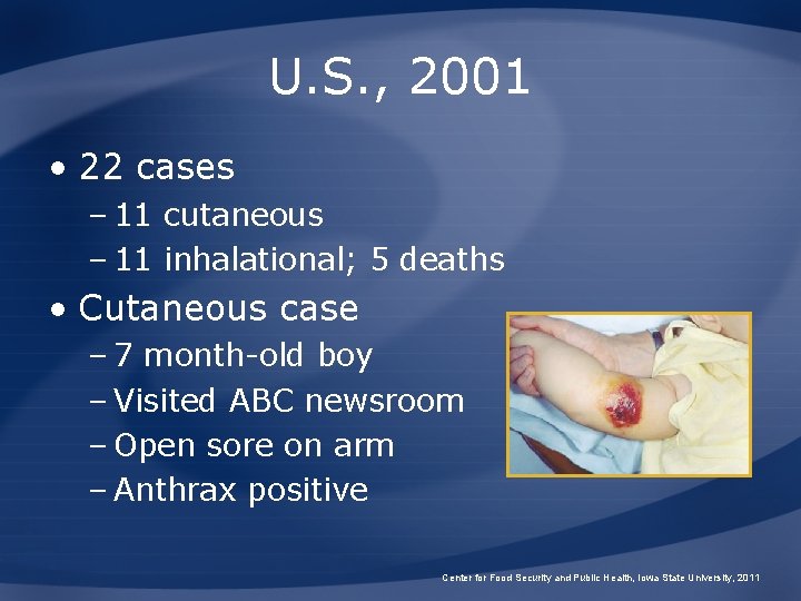 U. S. , 2001 • 22 cases – 11 cutaneous – 11 inhalational; 5