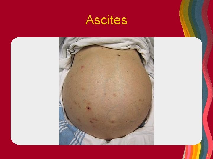 Ascites 15 