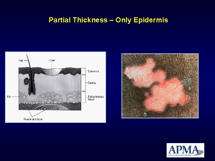 Partial Thickness – Only Epidermis Partial Thickness – Only Epidermis