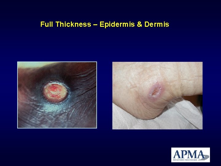 Full Thickness – Epidermis & Dermis Full Thickness – Epidermis & Dermis