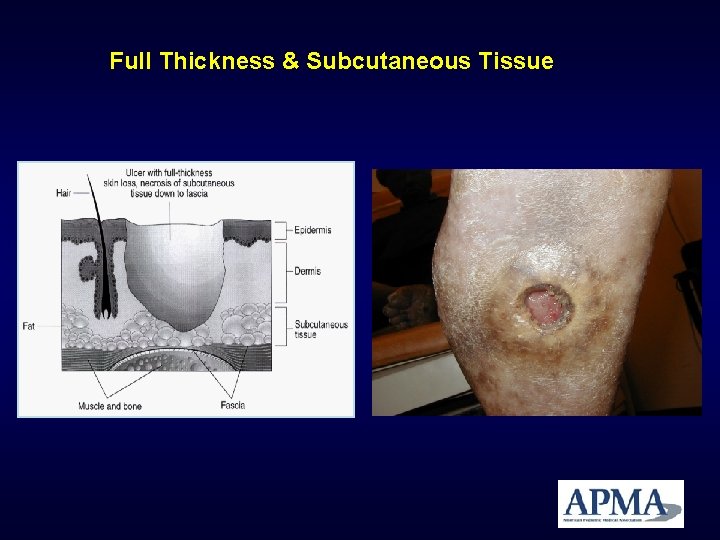 Full Thickness & Subcutaneous Tissue Full Thickness & Subcutaneous Tissue