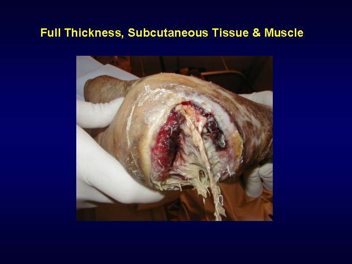 Full Thickness, Subcutaneous Tissue & Muscle Full Thickness, Subcutaneous Tissue & Muscle