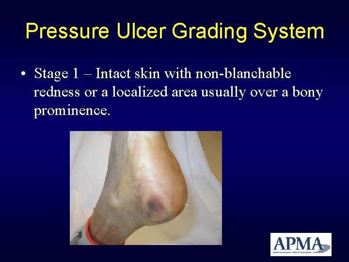 Pressure Ulcer Grading System • Stage 1 – Intact skin with non-blanchable redness or Pressure Ulcer Grading System • Stage 1 – Intact skin with non-blanchable redness or