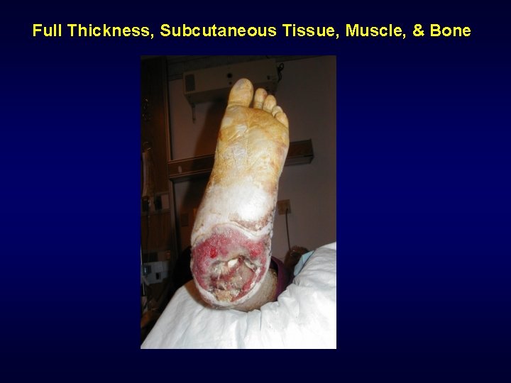 Full Thickness, Subcutaneous Tissue, Muscle, & Bone Full Thickness, Subcutaneous Tissue, Muscle, & Bone
