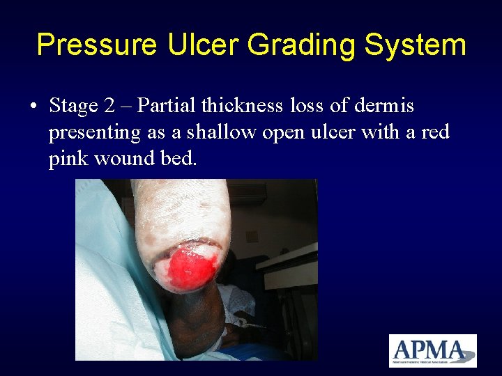 Pressure Ulcer Grading System • Stage 2 – Partial thickness loss of dermis presenting Pressure Ulcer Grading System • Stage 2 – Partial thickness loss of dermis presenting