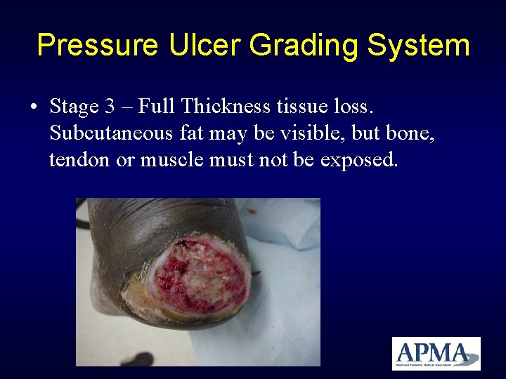 Pressure Ulcer Grading System • Stage 3 – Full Thickness tissue loss. Subcutaneous fat Pressure Ulcer Grading System • Stage 3 – Full Thickness tissue loss. Subcutaneous fat