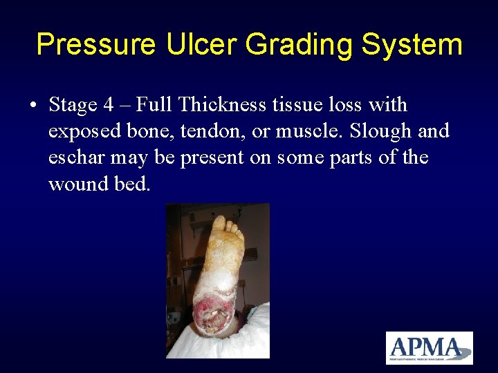 Pressure Ulcer Grading System • Stage 4 – Full Thickness tissue loss with exposed Pressure Ulcer Grading System • Stage 4 – Full Thickness tissue loss with exposed